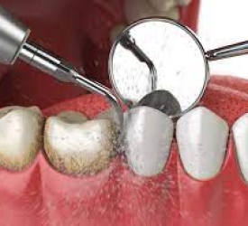 Cạo Vôi Răng & Điều Trị Viêm Nha Chu