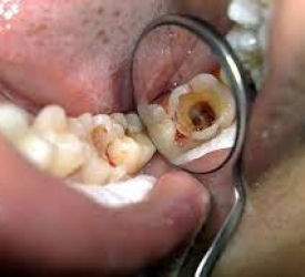 Điều Trị Tủy Răng