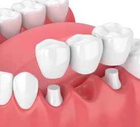 Phục hình răng cố định