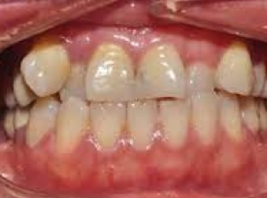 Răng khấp khểnh